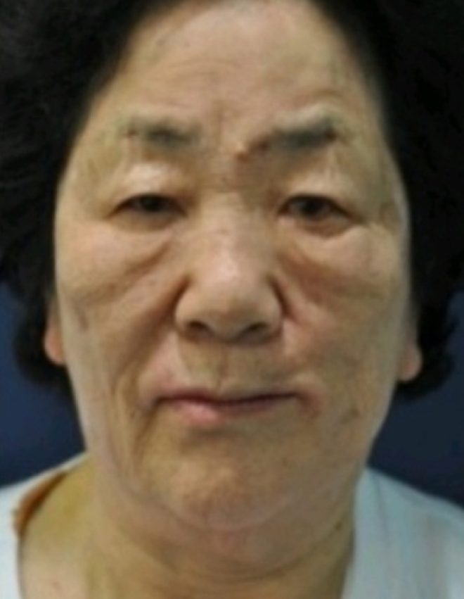 수술 직후 — 75세 안면비대칭 교정
