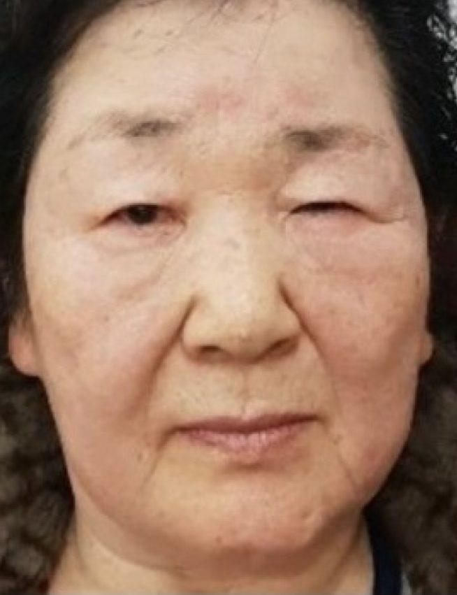 수술 후 23개월 경과 — 75세 안면비대칭 교정