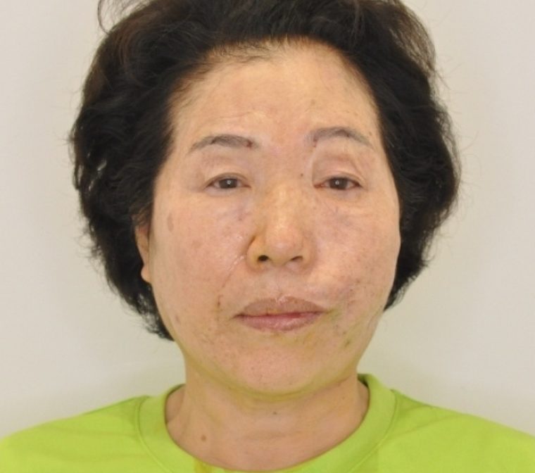 수술 직후 (당일) — 70세 안면비대칭 교정