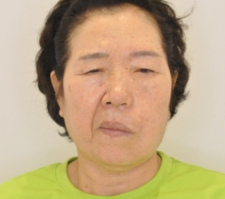 수술 전 — 70세 안면비대칭 교정