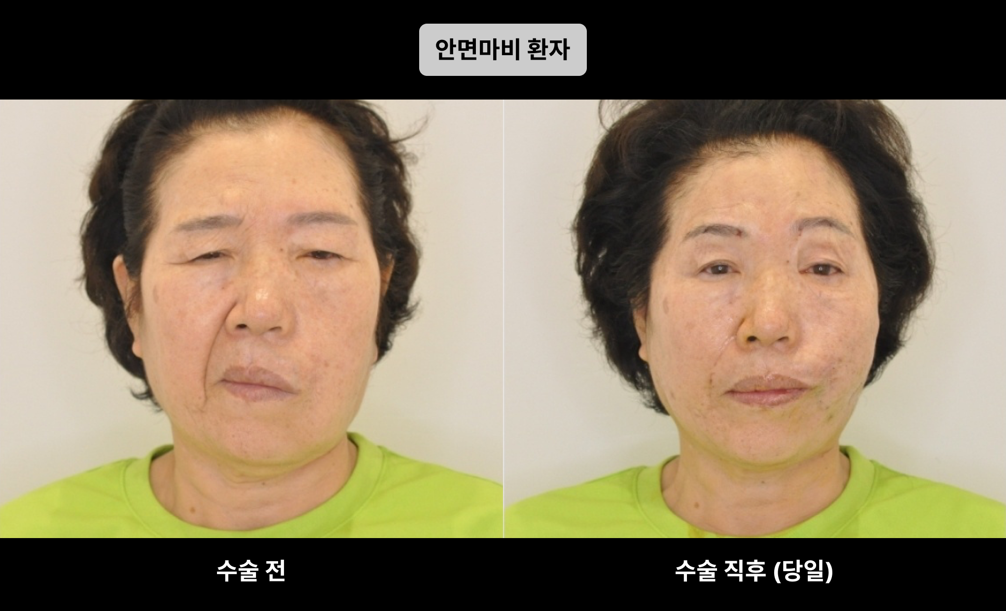 안면 마비로 인한 안면비대칭 교정 시술 전후 비교 사진