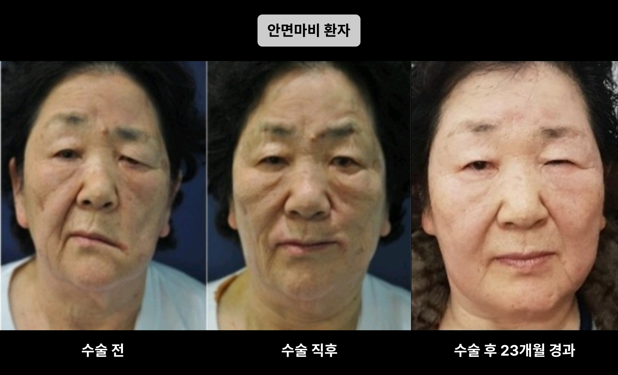 안면 마비 교정 후 개선된 얼굴 라인과 대칭이 확연해진 모습